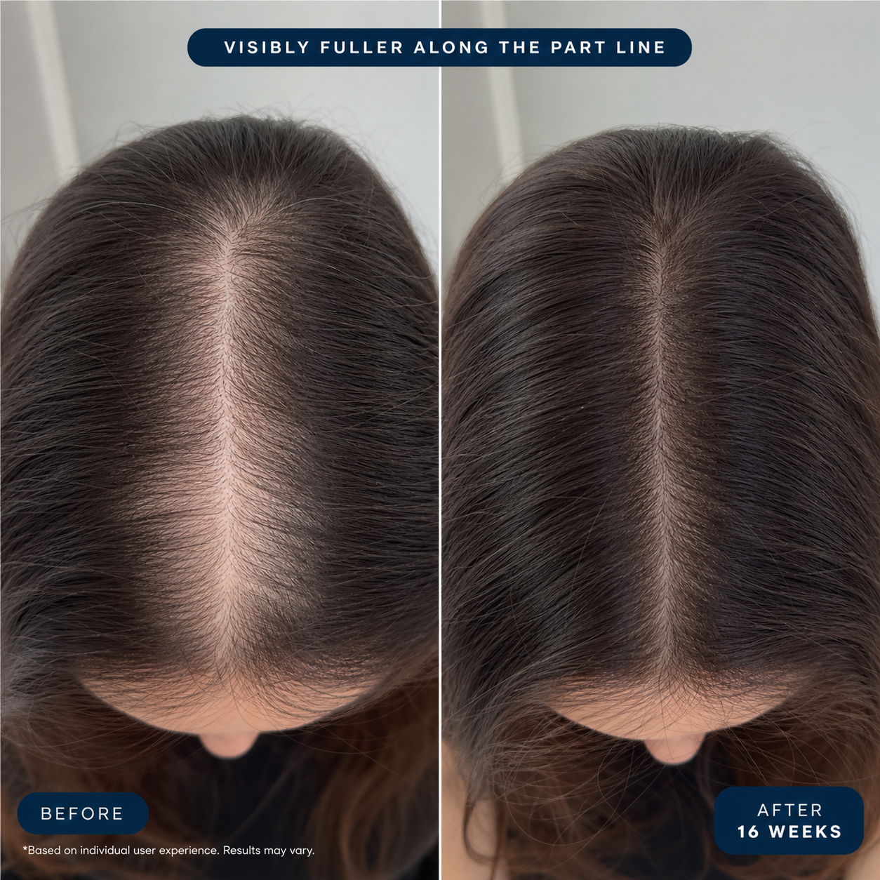 The Micro-Infusion Hair Recovery System