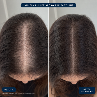 The Micro-Infusion Hair Recovery System